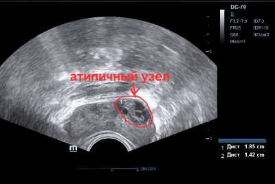 ТРУЗИ, атипичный узел
